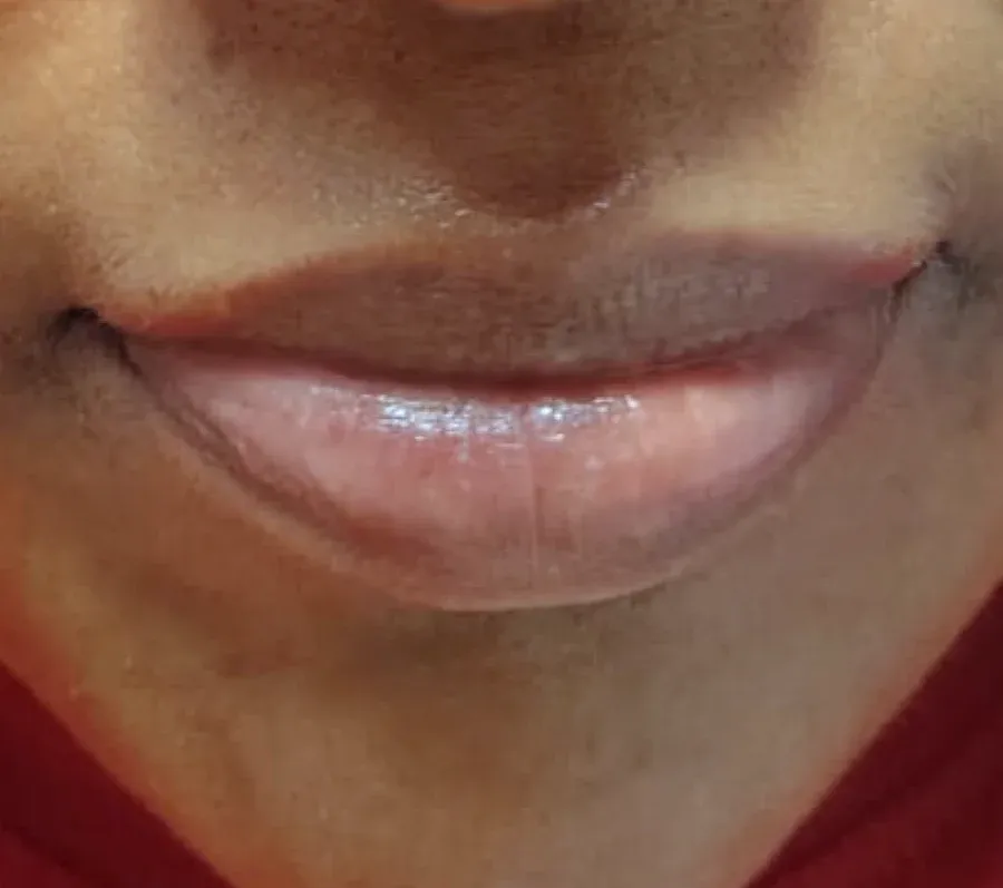 After: a client's lips, darker before treatment and more even in tone after
