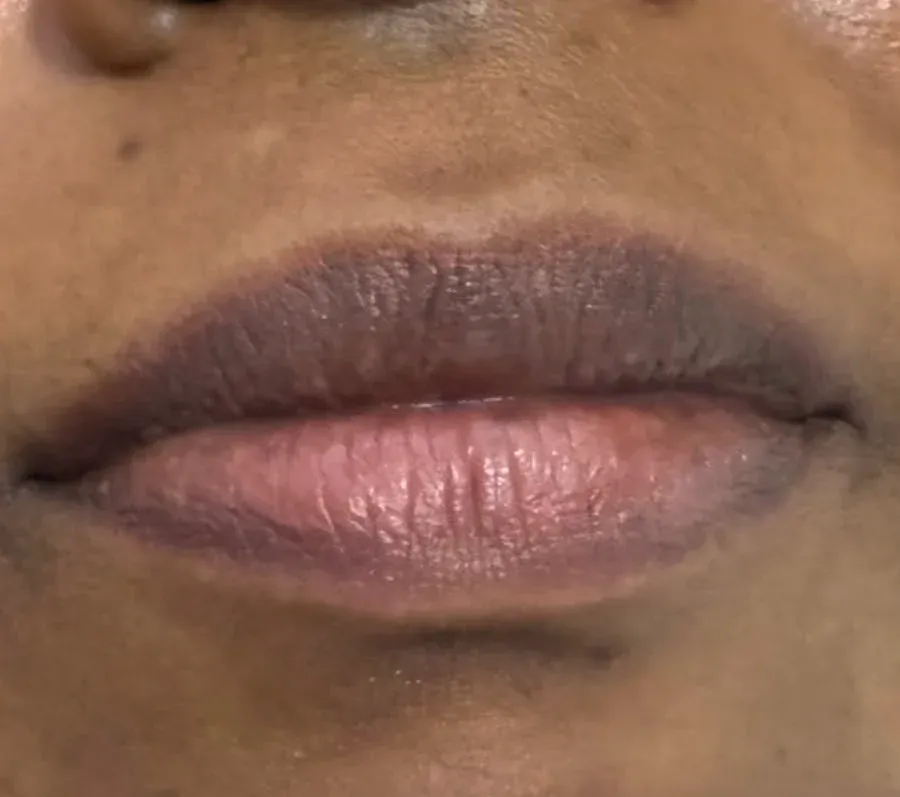 Before: a client's lips, darker before treatment and more even in tone after