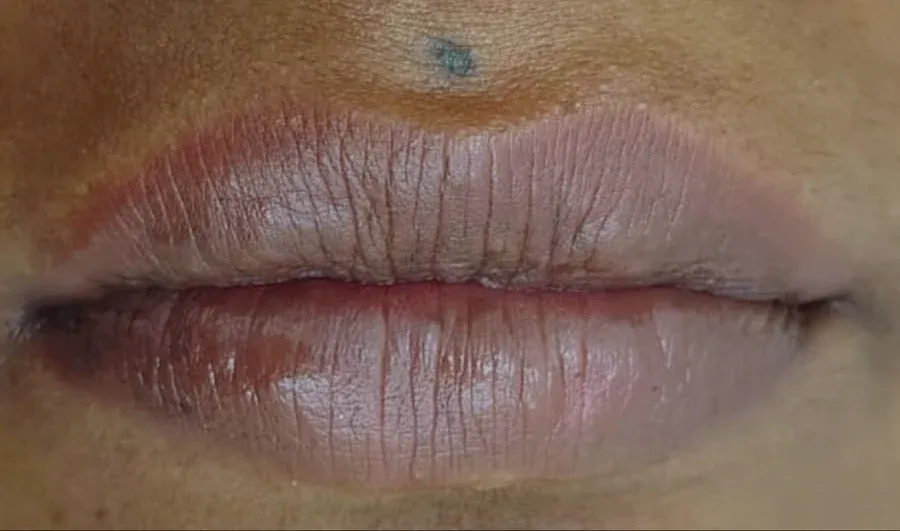After: a client's lips, darker before treatment and more even in tone after